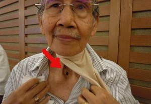 Leher Berlubang Usai Kena Kanker Akibat Merokok 
