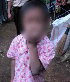 Biaya Jadi Kendala Pengobatan Bocah Perokok