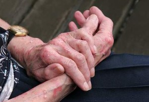 Angioedema, Pembengkakan Karena Gatal-Gatal
