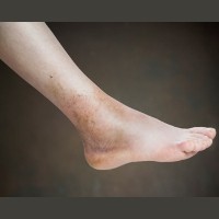 Cedera Kaki Ringan Jangan Didiamkan
