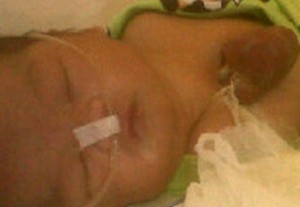 Siti Arrahma, Bayi yang Terlahir dengan Jantung di Luar Tubuh