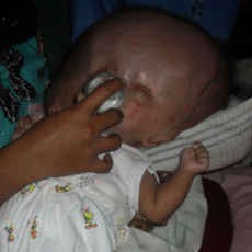 Sejak Lahir Haidar Tergolek Lemah Karena Penyakit Hydrocephalus
