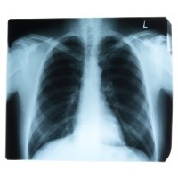 Pasien Kanker Paru yang Kena Diabetes Hidupnya Lebih Lama