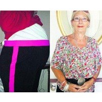 Nenek 60 Tahun Dikira Hamil Padahal Tumor Raksasa