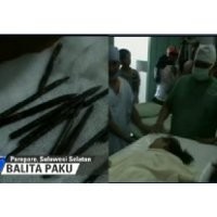 25 Paku Masuk ke Dalam Tubuh Sulit Dijelaskan Secara Medis