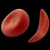 Harapan Baru untuk Pengobatan Anemia Sel Sabit