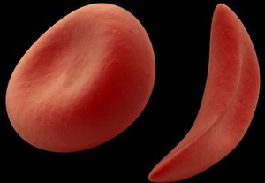 Harapan Baru untuk Pengobatan Anemia Sel Sabit