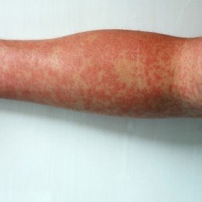 Kenapa Campak Bisa Menular dengan Cepat?