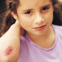 Ini Caranya Agar Luka Tak Menimbulkan Bekas