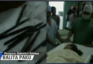 Menkes: Asal Muasal Paku di Kaki Safira Masih Misterius
