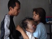 Tumor Mata Farisa Tak Bisa Dioperasi di RS Cicendo