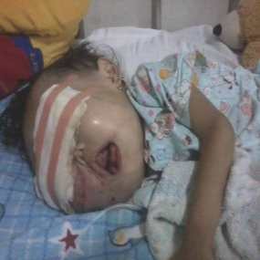 Farisa, Balita Penderita Tumor Mata Meninggal Dunia