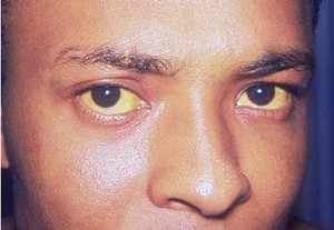 Jika Tubuh Jadi Kuning, Tanda Hepatitis A Sudah Mulai Sembuh