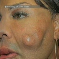 Pipi Mengeras Karena Ditambal Semen oleh Dokter Palsu