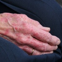 Pengobatan Baru untuk Eksim Karena Jamur Ditemukan