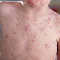 53+ Gambar Virus Cacar Air Dan Penjelasannya Terbaik 53+ Gambar Virus Cacar Air Dan Penjelasannya Terbaik