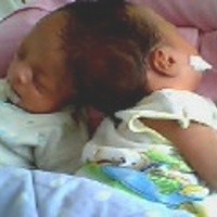 Operasi Kembar Dempet Kepala yang Gagal Masuk Tipe Paling Berat