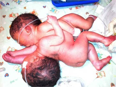 Bayi Perempuan Kembar Dempet Asal Riau Akan Dirujuk ke RSCM