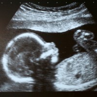 Duh! Aborsi Dianggap Lebih Aman dari Persalinan