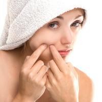 Obat-obat Jerawat ala Rumah