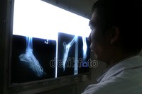 Dokter RS Akademis sedang memperhatikan foto rontgen kaki Dg Intang yang patah akibat tertabrak Avanza.