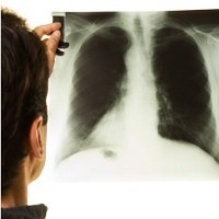 80 Persen Orang Indonesia Pernah Terpapar Kuman TB