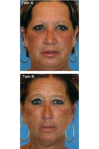 Beginilah Potret Wajah Para Perokok