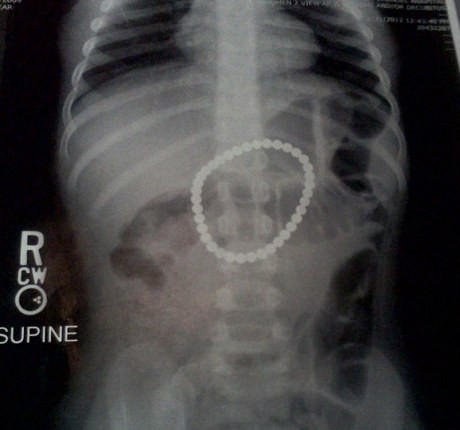 Aduh... Balita Telan 37 Magnet!