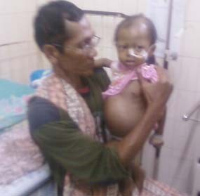 Balita 22 Bulan Berjuang Melawan Tumor Liver