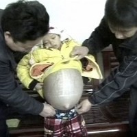 Remaja Berperut Buncit Seperti Hamil Karena Penyakit Hati