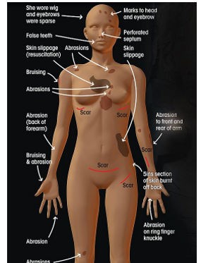 Hasil Autopsi: Ditemukan Banyak Luka di Tubuh Whitney Houston