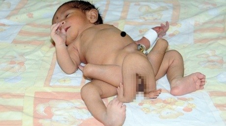 Dokter Selamatkan Bayi dengan 6 Kaki di Pakistan