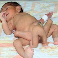 Kembar Gagal, Kaki dan Tangan Nemplok di Kaki Bayi yang Hidup