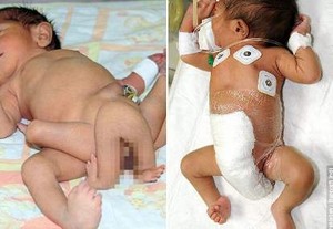 4 Kaki Tambahan Milik Bayi Berkaki 6 Berhasil Diangkat