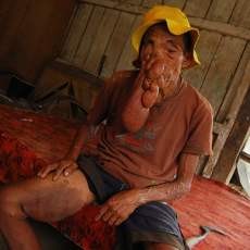 Ironis, Tak Ada Biaya, Wajah Samad Nyaris Tertutup Tumor Ganas