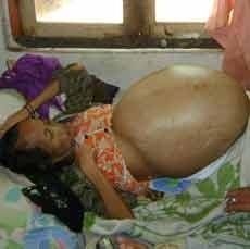 Seorang Ibu Menderita Tumor Perut Sejak 5 Tahun Lalu
