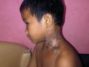 Ayah-Anak Warga Pesanggrahan Terkena Serangan Tomcat