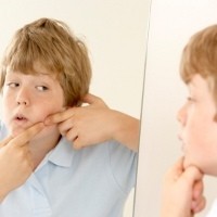 Jerawatan Bikin Remaja Jadi Gampang Emosional