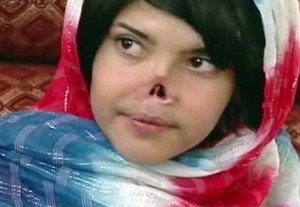 Kisah Aesha si Hidung Terpotong yang Berjuang Lawan Luka Mental