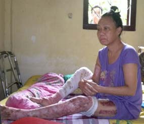 Purwaningsih, Satu Korban Lumpur Lapindo Cacat Seumur Hidup