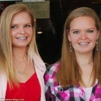 Gadis Kembar Cermin, Identik Tapi Organnya Saling Berlawanan