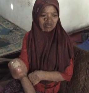 Sekujur Kulit Maslikah Dipenuhi Gelembung Hingga Terasa Panas