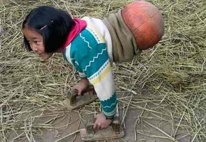 Gadis Bola Basket, Jalan Pakai Bola Basket Karena Tak Punya Kaki