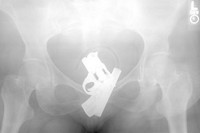 Tim bedah kandungan di sebuah rumah sakit panik saat foto sinar X menunjukkan ada pistol terjebak di vagina seorang pasien, dengan posisi seperti sudah terkokang dan siap ditembakkan. Operasi dilakukan dengan rompi antipeluru, tapi setelah dikeluarkan ternyata hanya korek gas yang bentuknya mirip pistol. (Foto: Neatorama)