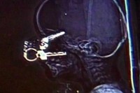 Nicholas Holderman, seorang laki-laki asal Kentucky mengalami cedera fatal saat terjatuh. Kunci mobil yang dipegangnya menancap di wajah, menembus kelopak mata dan tulang tengkorak hingga ke otak. Beruntung, tidak ada kerusakan permanen yang dialaminya. (Foto: The Times)