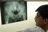 Fateh Mohammad, seorang napi di Pakistan mengaku tidak tahu apa-apa saat bangun pagi dan merasa ada yang tidak nyaman di anusnya. Mungkin ada teman satu sel yang jahil, hasil pemindaian dengan sinar X menunjukkan ada bohlam lampu pijar terjebak di anusnya. (Foto: Typepad)