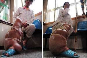 Kaki Terus Membengkak Seperti Gajah Usai Melahirkan