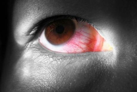 Waspadai Parasit Pelahap Mata Pada Lensa Kontak yang Kotor