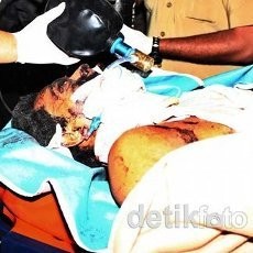 Terduga Pelaku Peledakan Bom Depok yang Terluka Parah Sudah Stabil