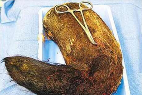 Seram! 1,8 Kg Rambut Dikeluarkan dari Perut sang Gadis